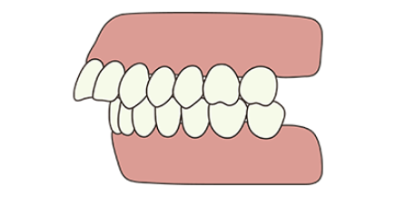 overbite-concept