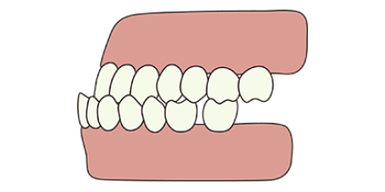 underbite-concept